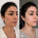 کرم ضد جوش و کنترل کننده چربی تراست - تصویر 3